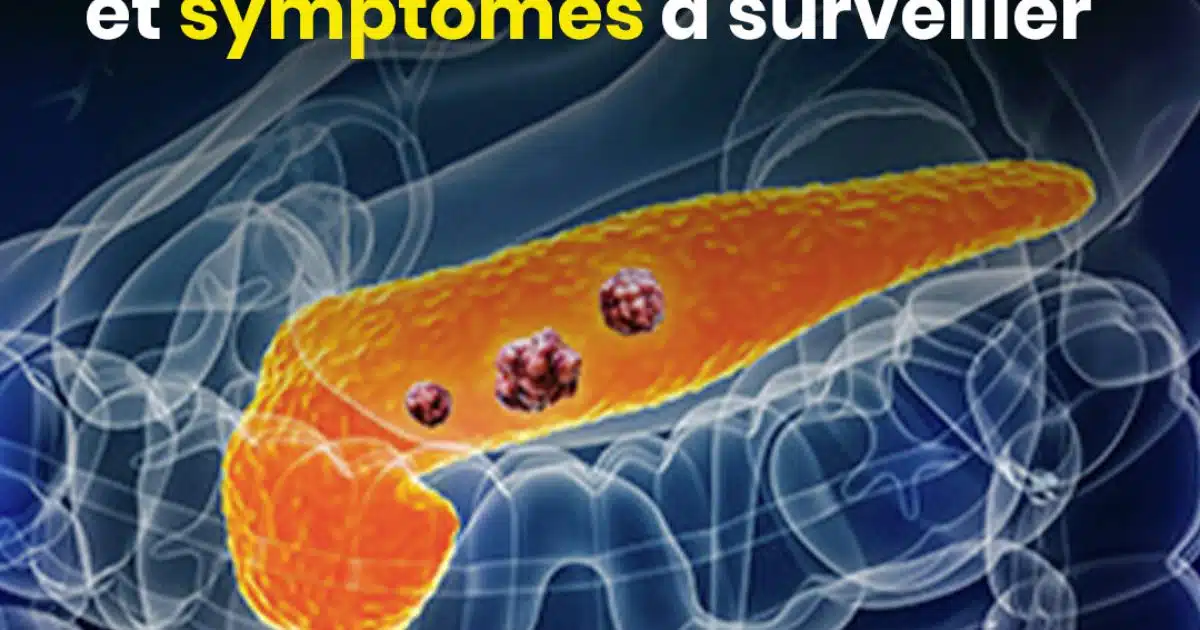 10 signes du cancer du pancréas à ne pas ignorer