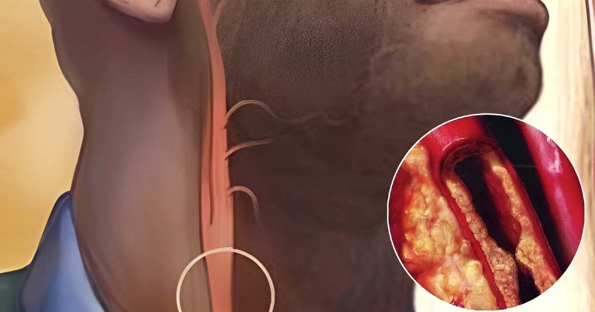 10 signes pour identifier des artères obstruées