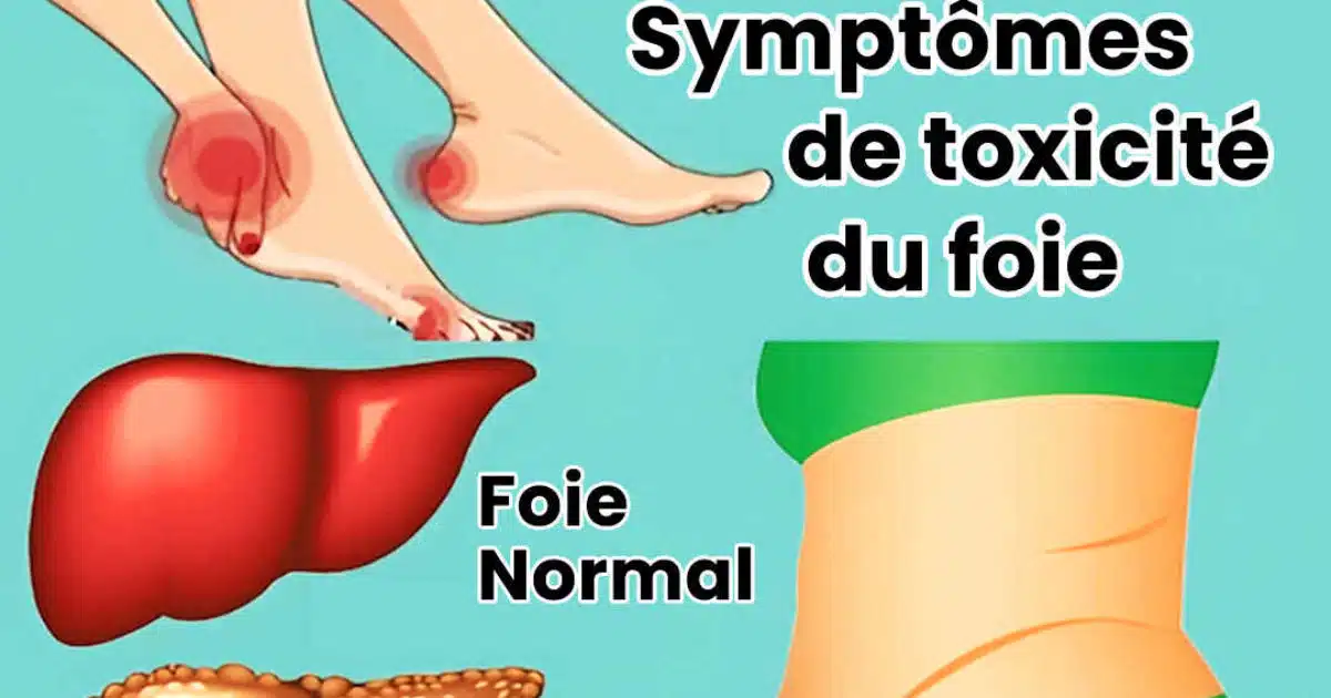 11 indices indiquant un dysfonctionnement du foie et une accumulation de toxines dans votre organisme