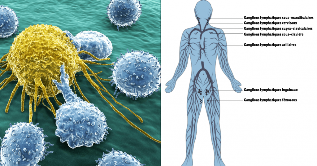 Le cancer lymphatique : tueur silencieux ou maladie évitable?