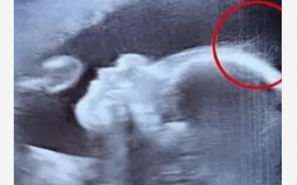 Échographie montrant un fœtus avec une chevelure visible