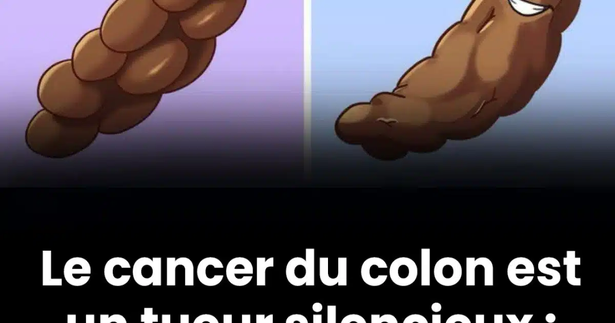 5 signes du cancer du colon