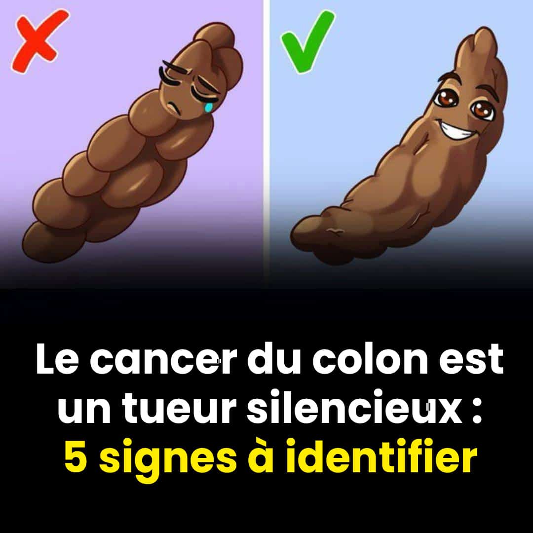 5 signes du cancer du colon