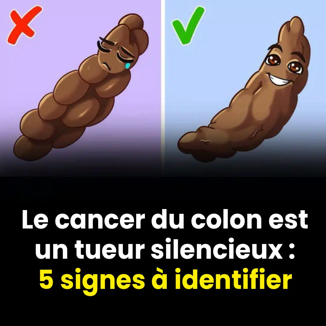 5 signes du cancer du colon