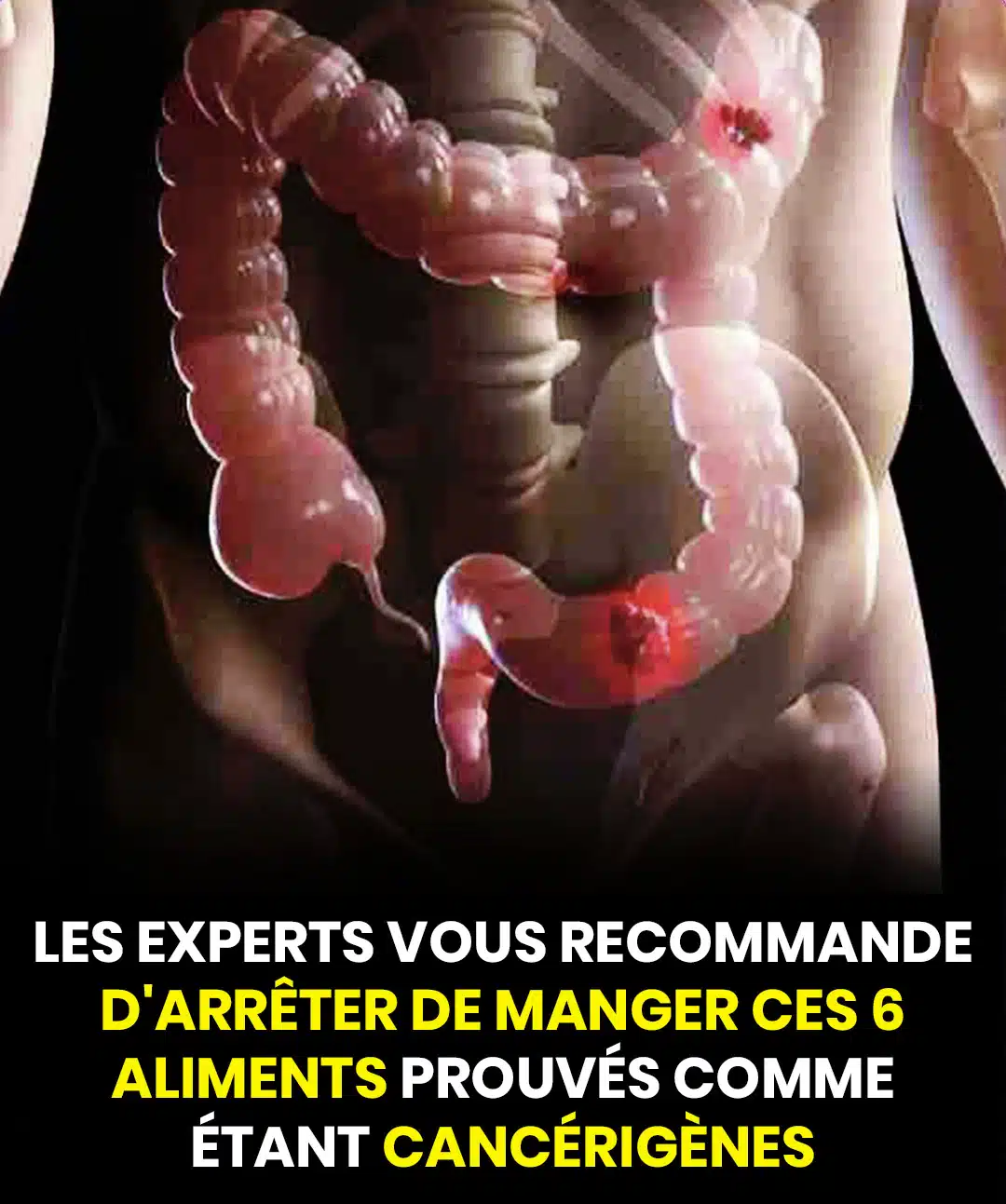 6 aliments potentiellement cancérigènes à éviter