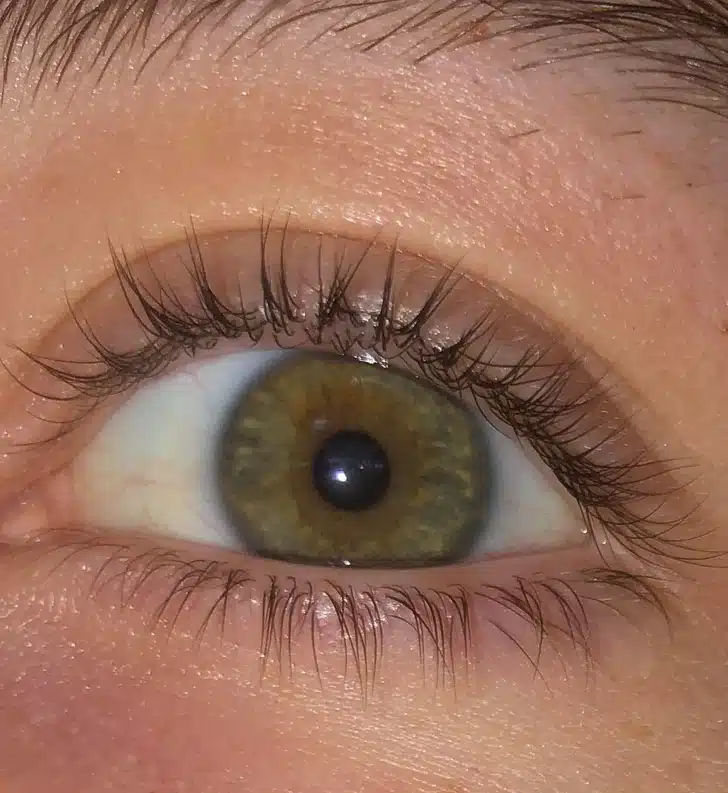 Double rangée de cils sur la paupière