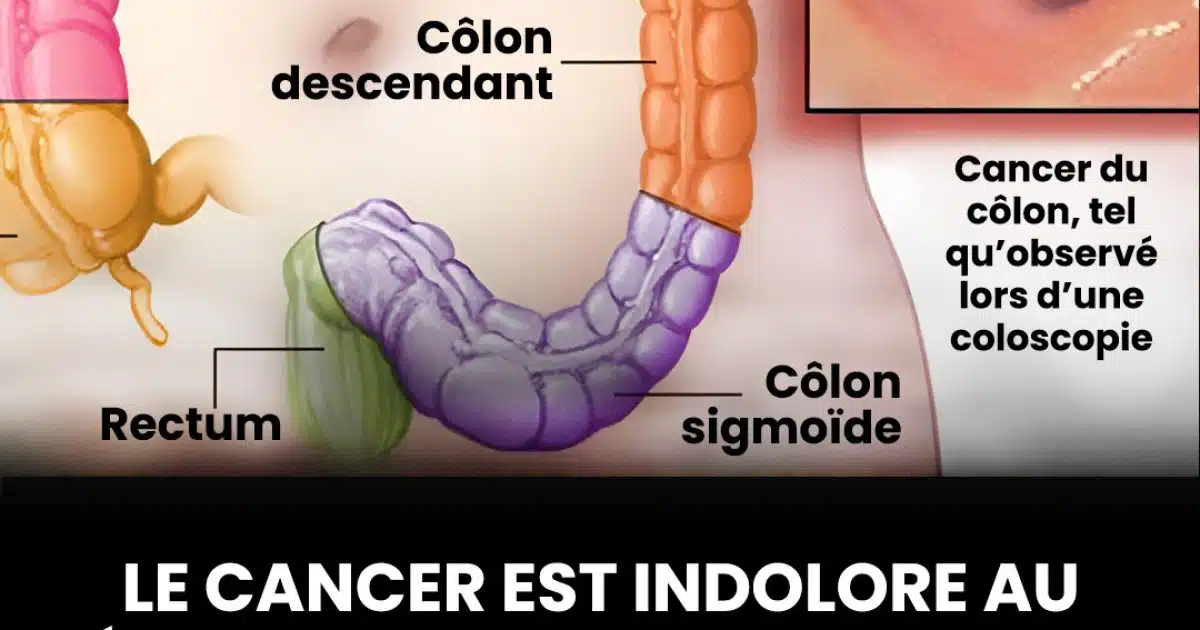 7 signes avant-coureurs du cancer du côlon que vous ne devriez jamais ignorer