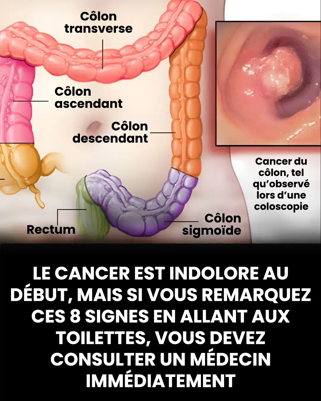 7 signes avant-coureurs du cancer du côlon que vous ne devriez jamais ignorer