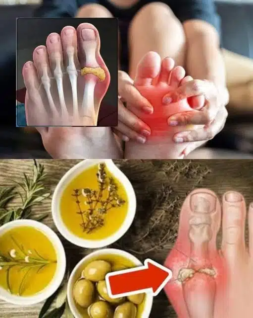 8 façons simples de réduire naturellement l'excès d'acide urique