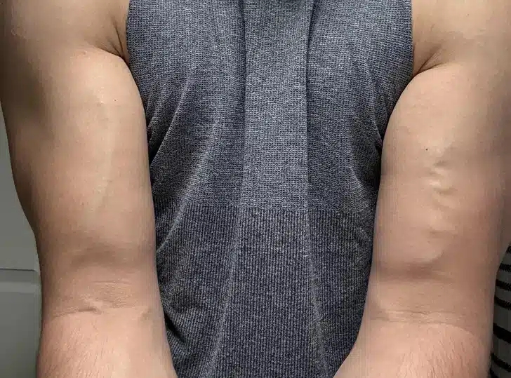 Différences veineuses entre les deux bras