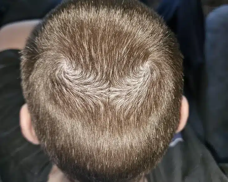 Double couronne de cheveux sur la tête