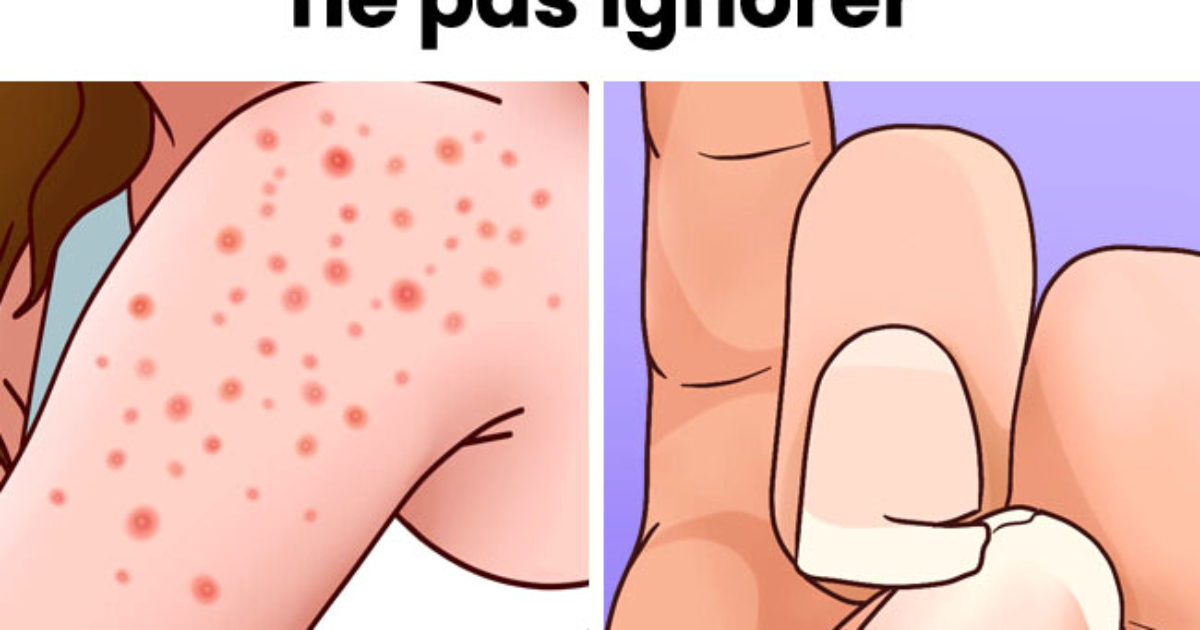 9 signes d'une allergie au gluten