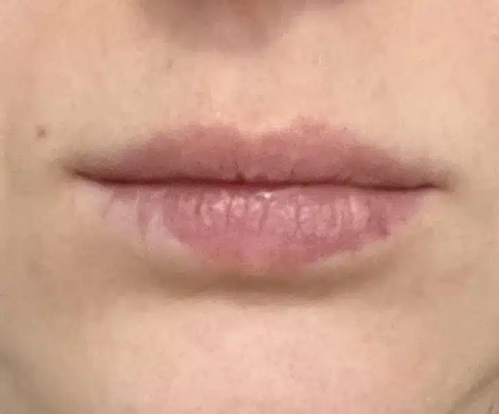 Lèvre inférieure avec zone dépigmentée