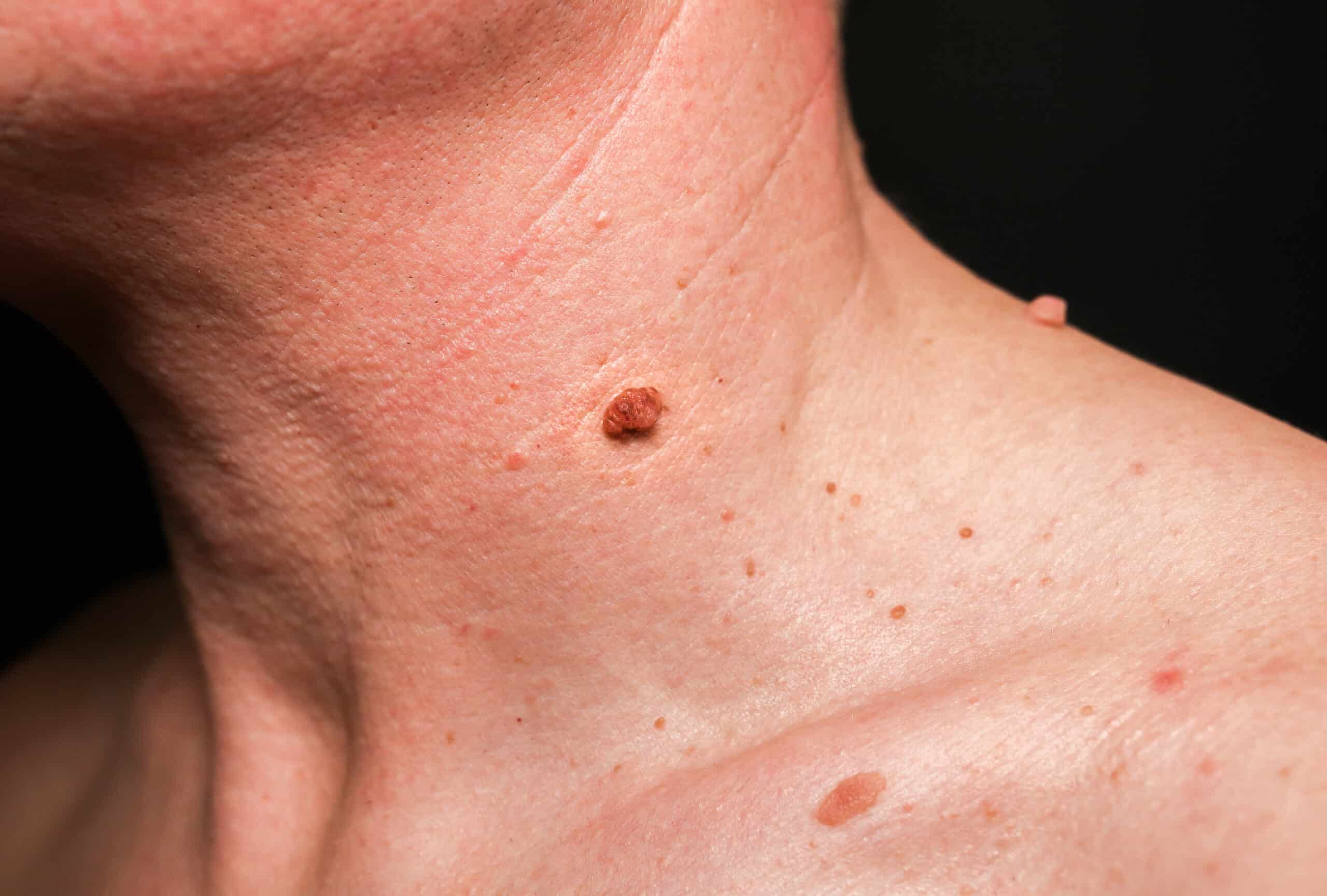 Détail sur une peau présentant de légères imperfections