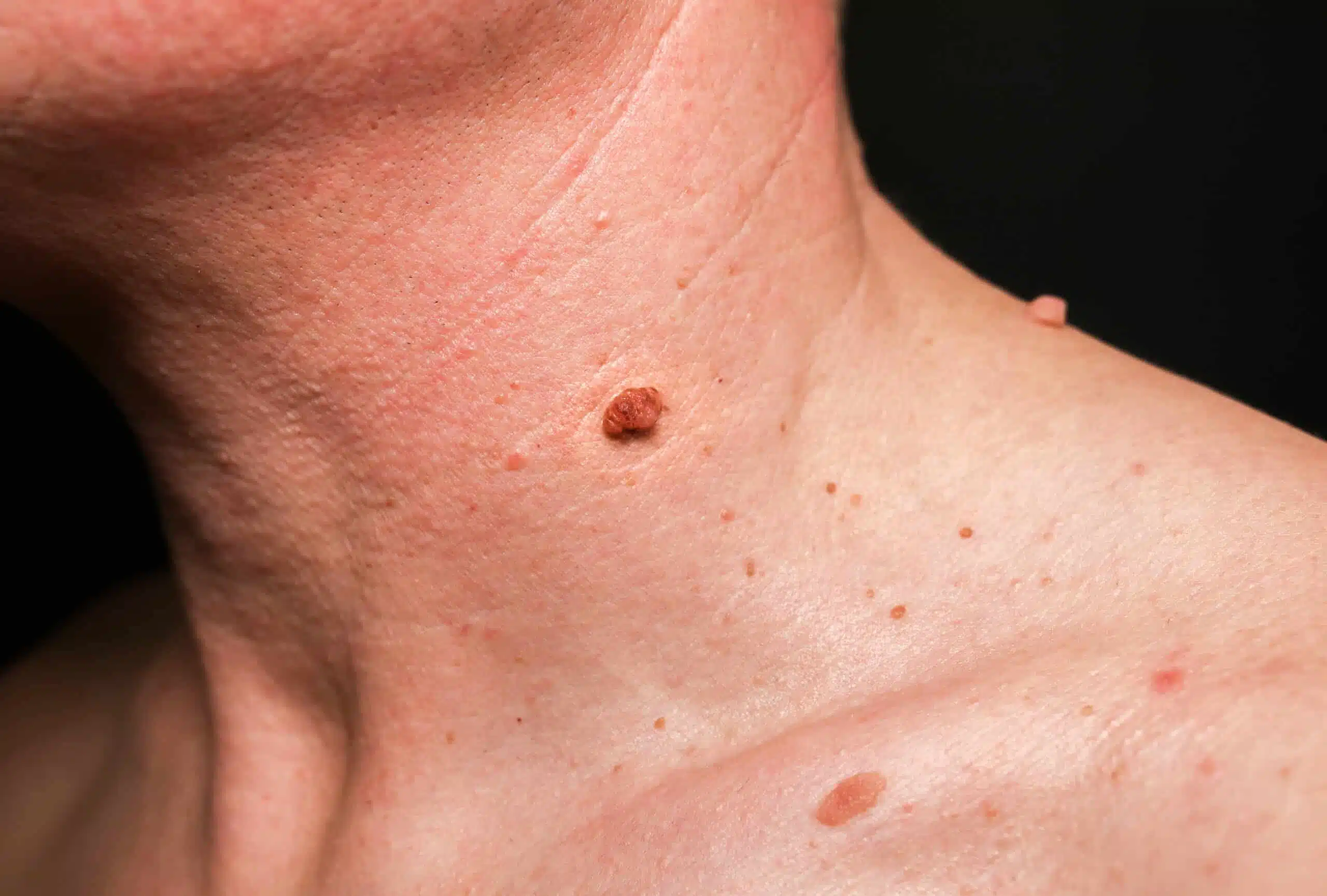 Détail sur une peau présentant de légères imperfections