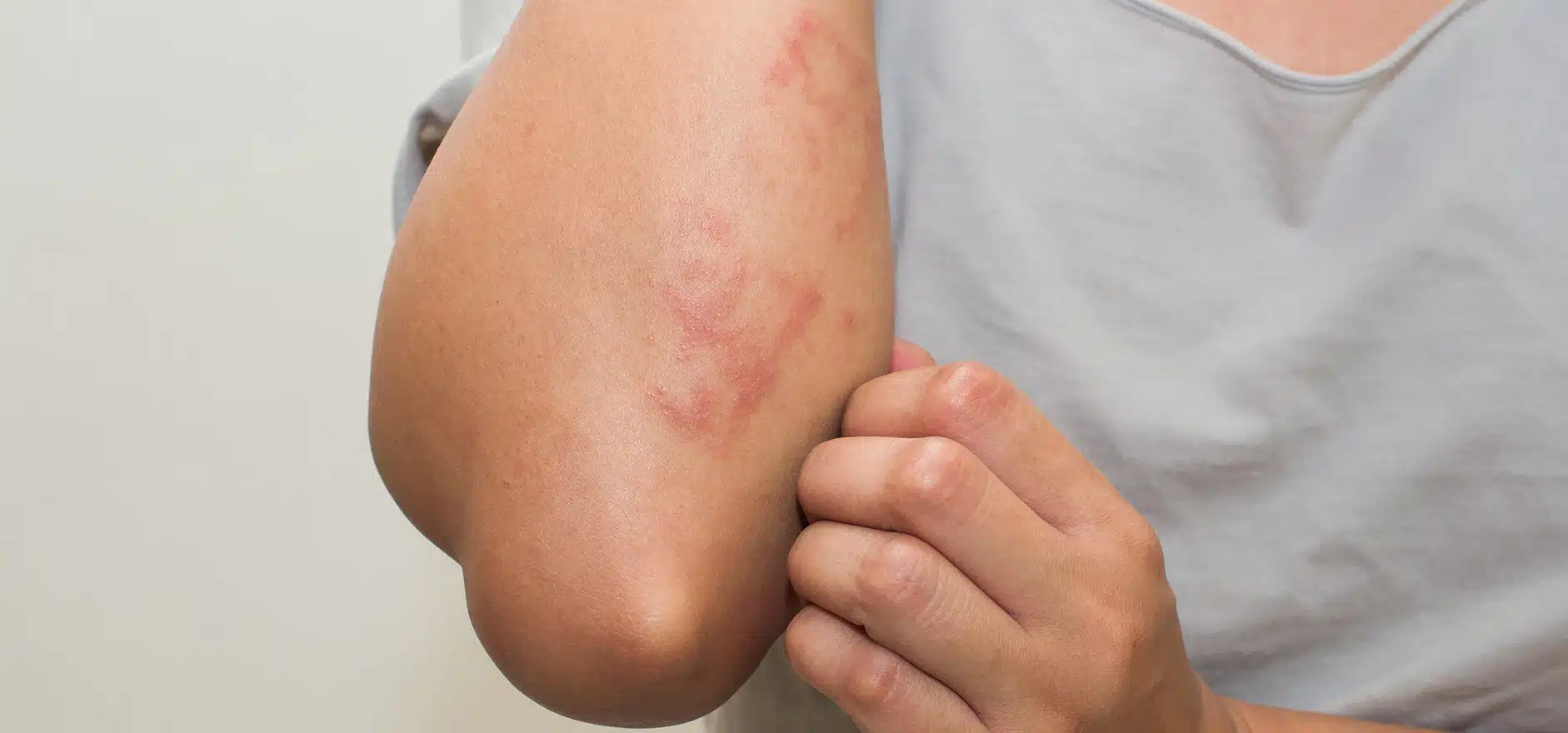 Femme observant une irritation cutanée sur son bras