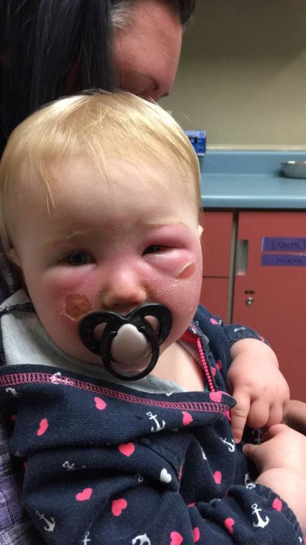 Ce bébé a eu des brûlures sévères