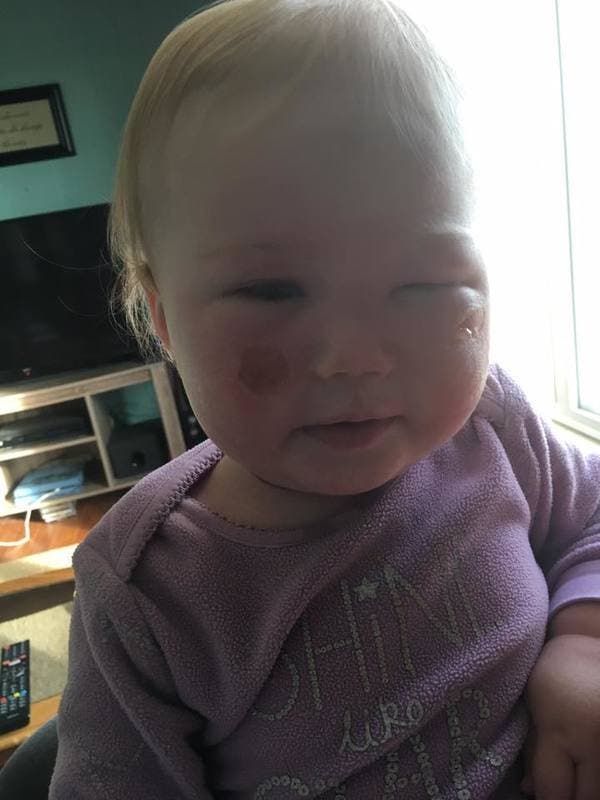 Ce bébé a eu des brûlures sévères