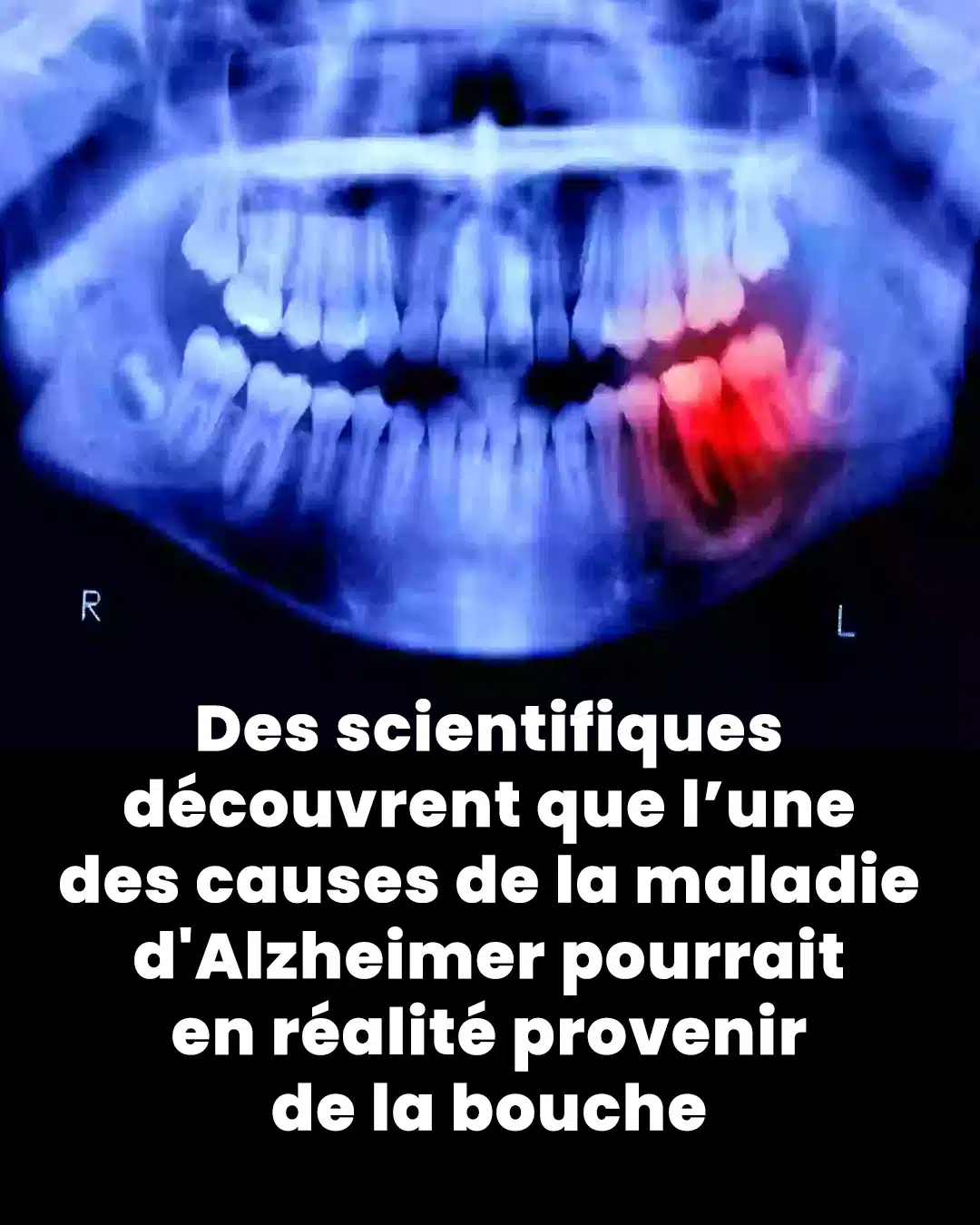 Des scientifiques découvrent que l’une des causes de la maladie d'Alzheimer pourrait en fait provenir de l'intérieur de votre bouche