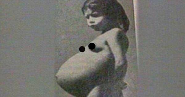 Tout le monde pensait que cette fille de 5 ans avait une tumeur