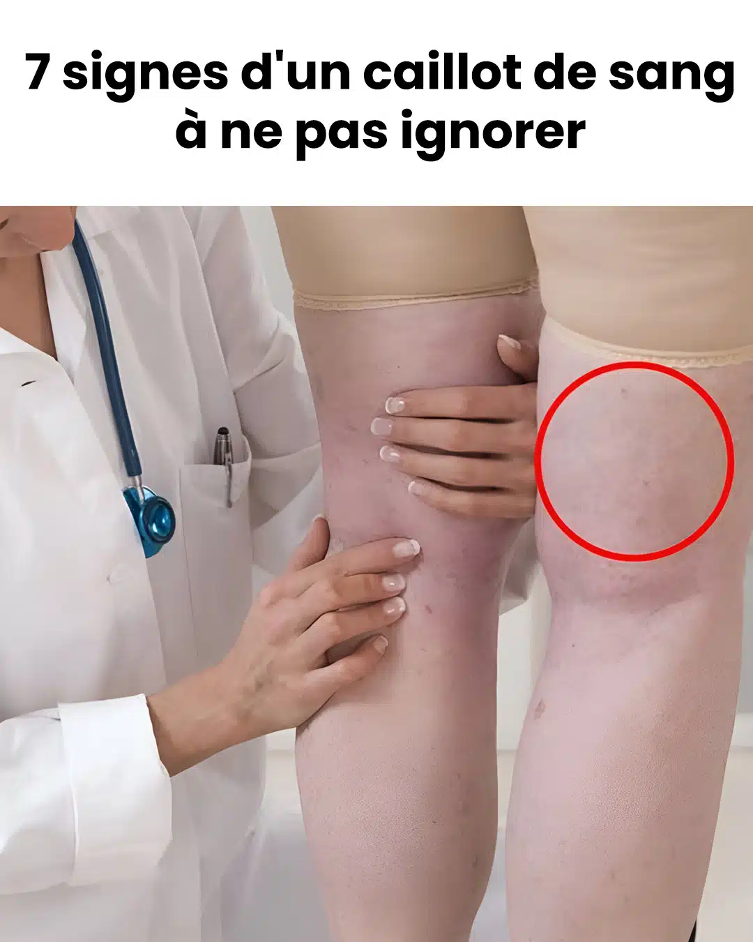 À quoi ressemble un caillot sanguin ? Les experts partagent les signes et symptômes courants