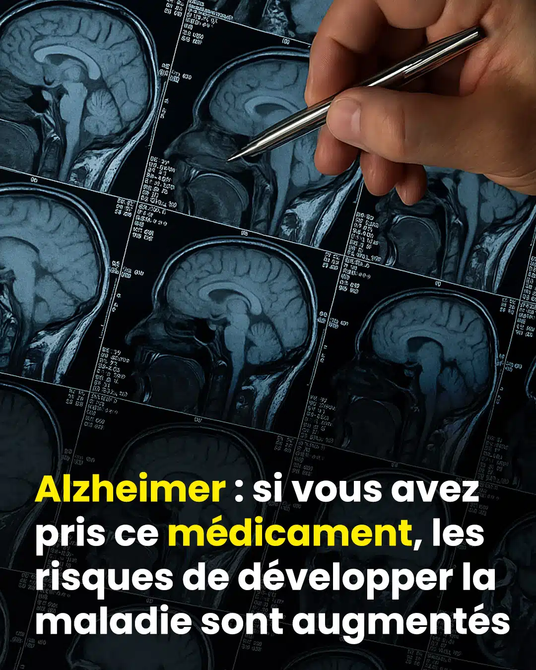 Alzheimer : 6 causes potentielles repérées et des moyens d’en réduire l’impact