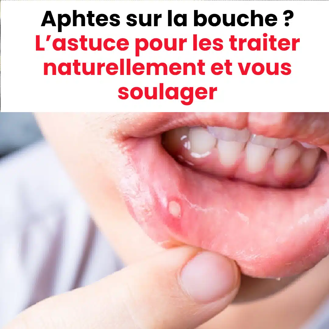 Aphtes : les meilleurs remèdes naturels pour les soulager