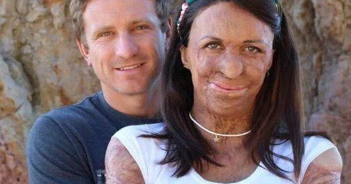 Après qu'un incendie a endommagé la beauté de sa femme, le mari refuse de la quitter