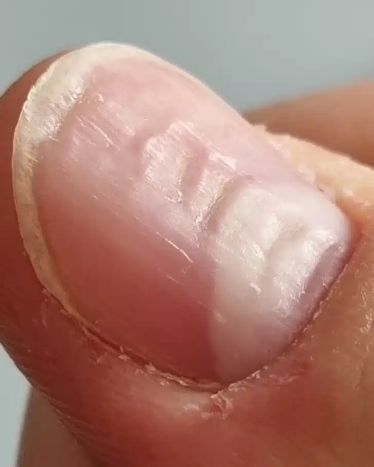 Ongle strié avec des rainures profondes