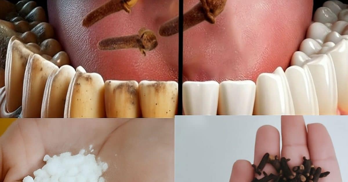Blanchiment dentaire : obtenez des dents blanches à la maison