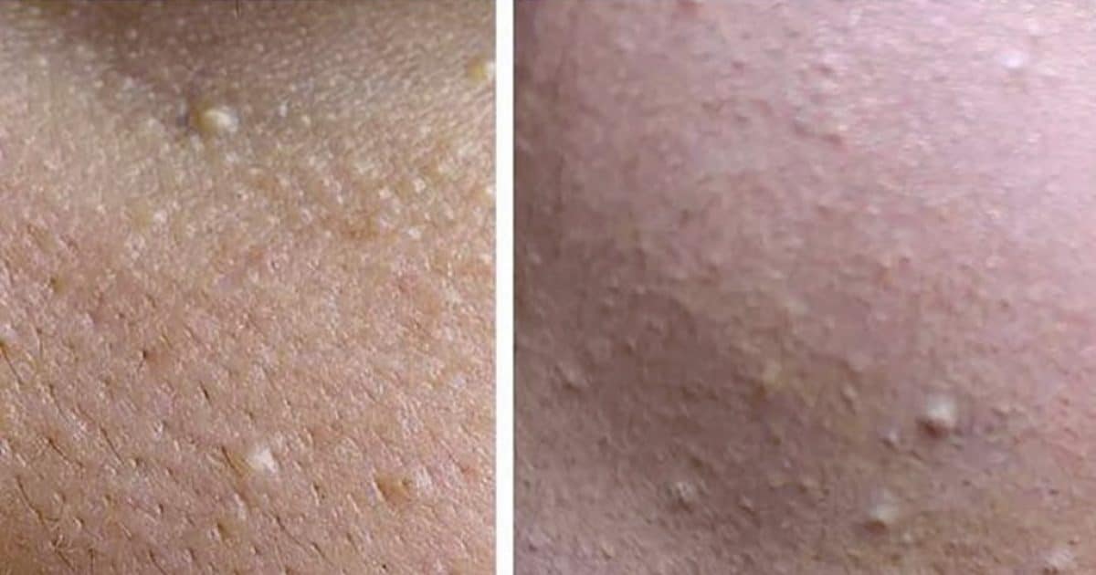 Boules blanches sur la peau : quelles significations ?