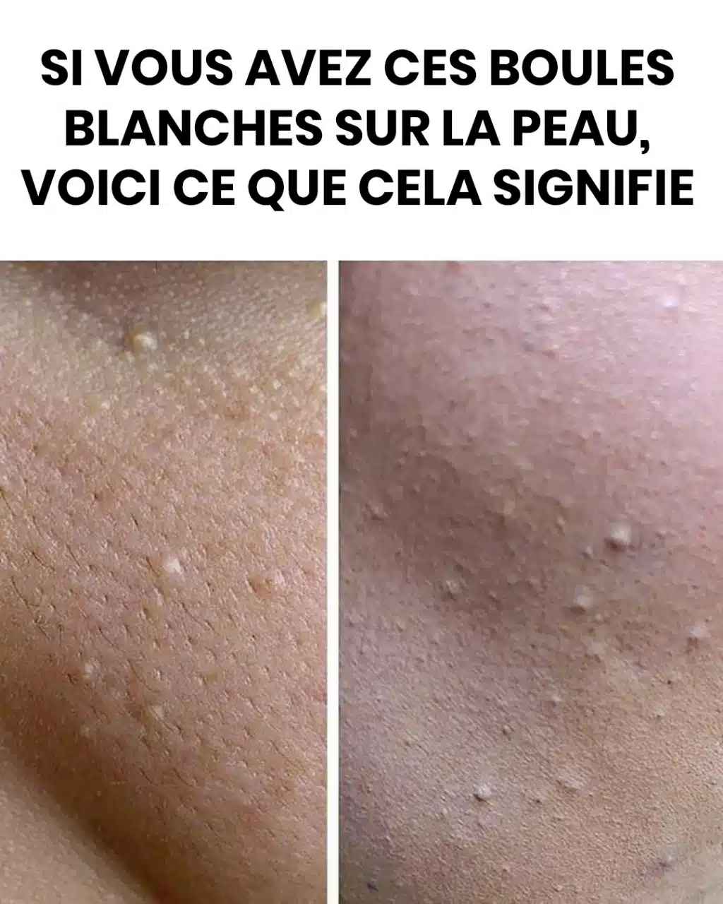 Boules blanches sur la peau : quelles significations ?