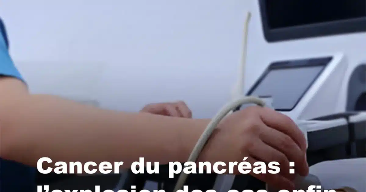Cancer du pancréas : les scientifiques lèvent enfin le voile sur l’explosion des cas