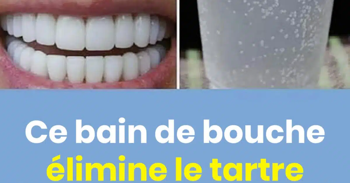 Ce bain de bouche élimine le tartre des dents naturellement