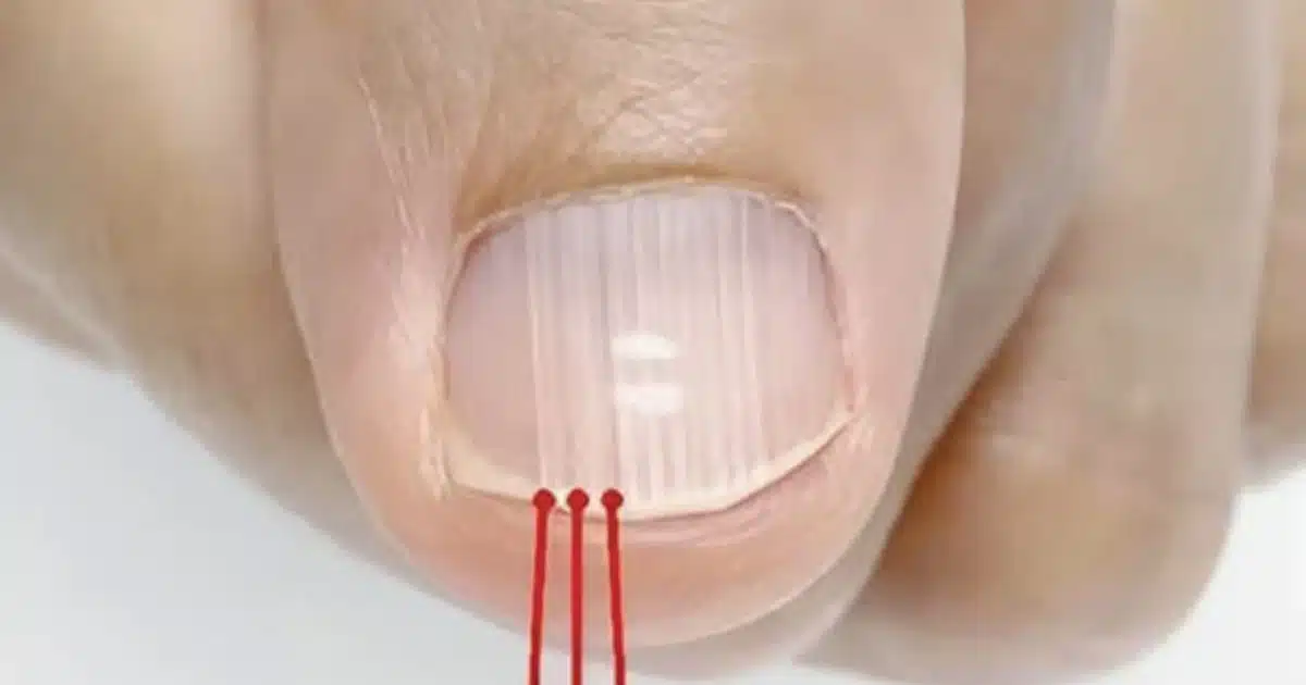 Ce que ces lignes verticales sur vos ongles révèlent réellement