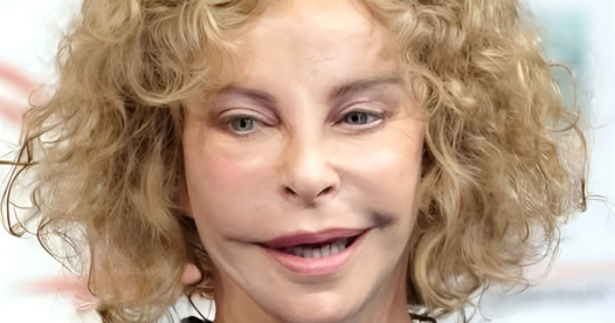 Ces stars qui ont abusé du bistouri