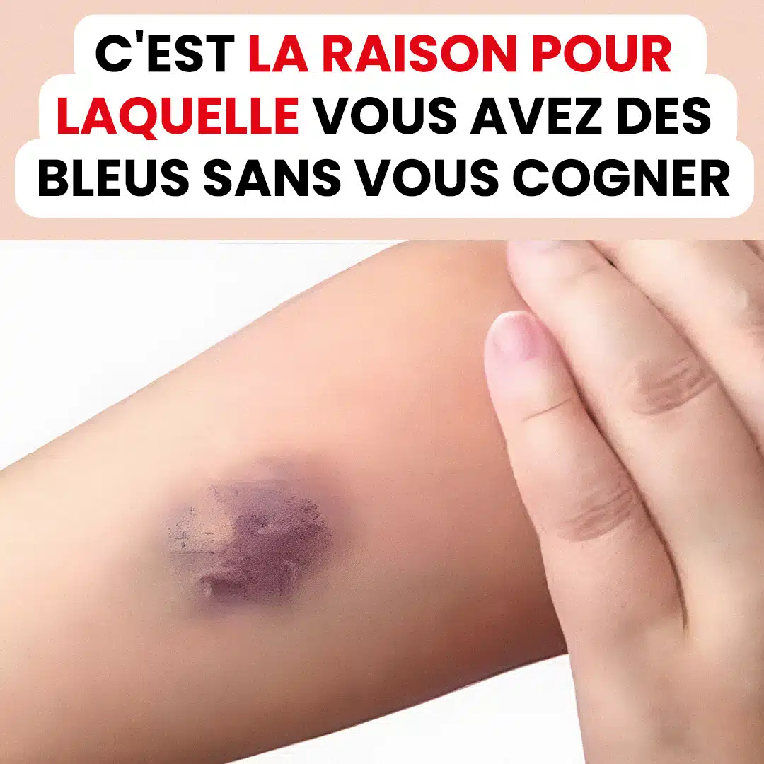 C'est la raison pour laquelle vous avez des bleus sur votre corps sans vous cogner