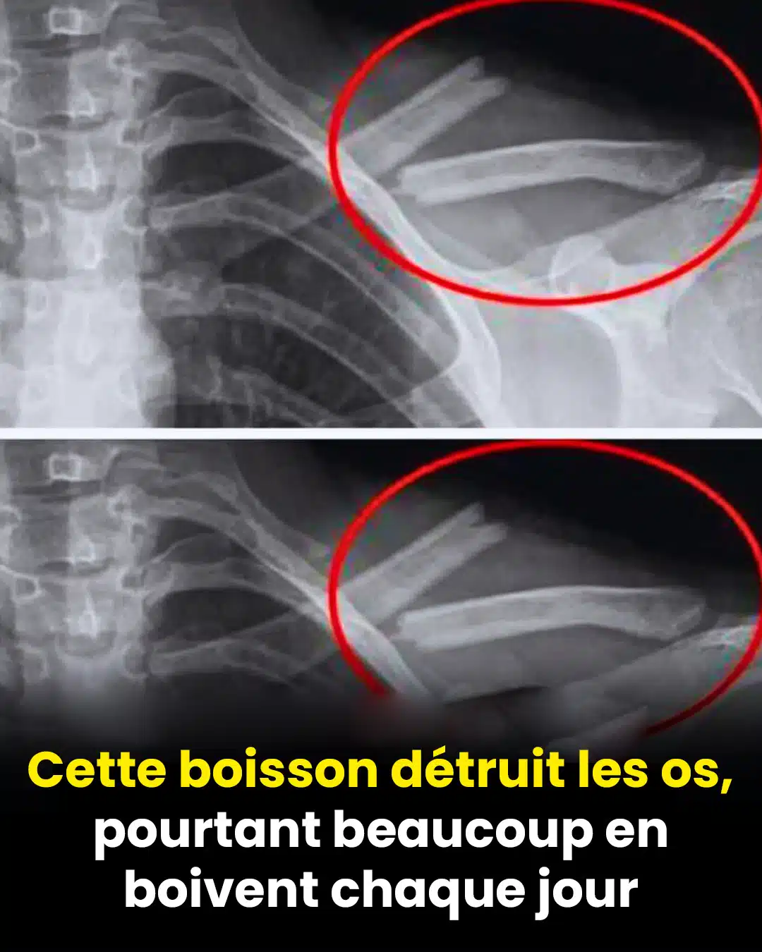 Cette boisson détruit les os, et pourtant, de nombreuses personnes en boivent tous les jours
