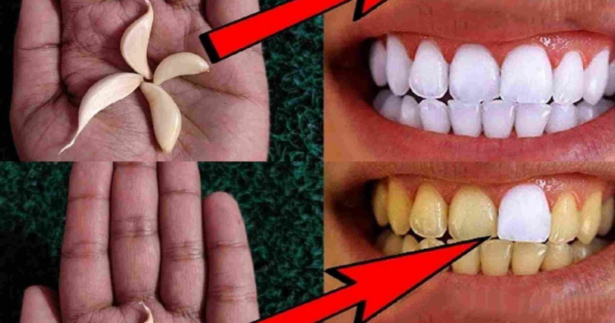 Comment blanchir les dents avec de l’ail ?