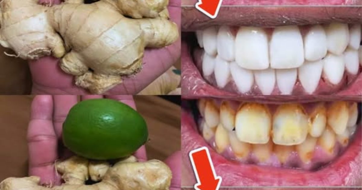 Comment blanchir les dents avec du citron et du gingembre ?