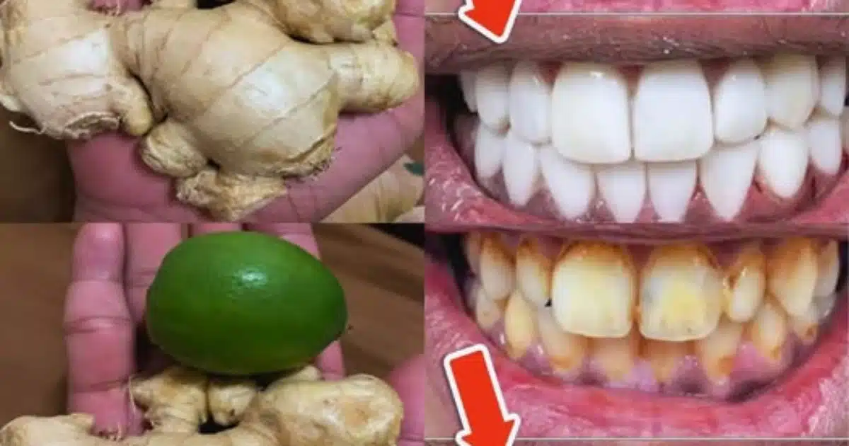 Comment blanchir les dents avec du citron et du gingembre ?