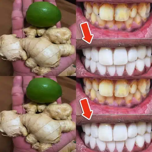 Comment blanchir les dents avec du citron et du gingembre ?