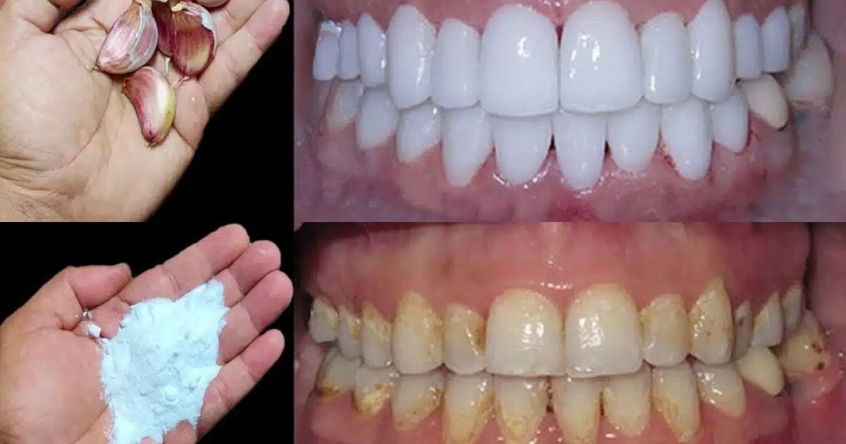 Comment blanchir les dents en 2 minutes ?
