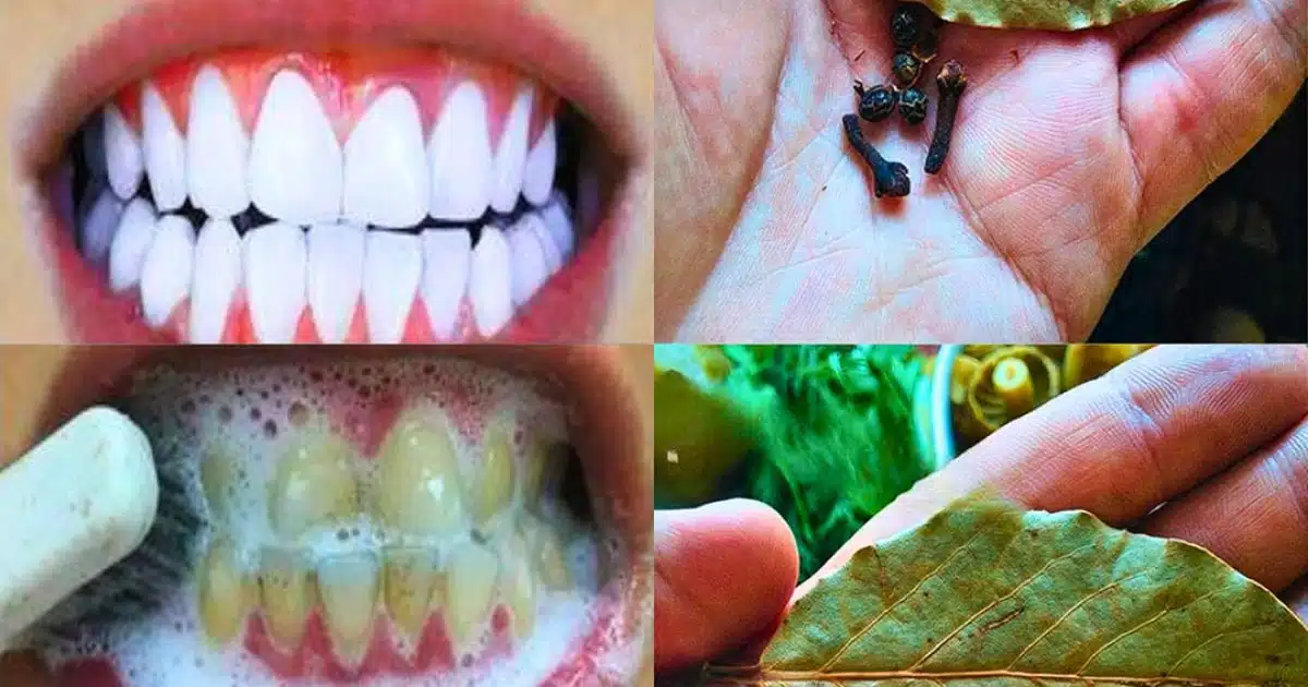 Comment blanchir ses dents avec des clous de girofle et des feuilles de laurier ?