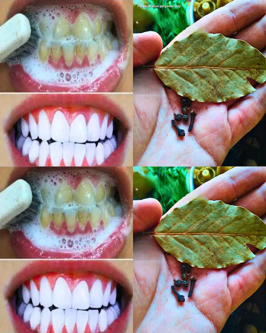 Comment blanchir ses dents avec des clous de girofle et des feuilles de laurier ?