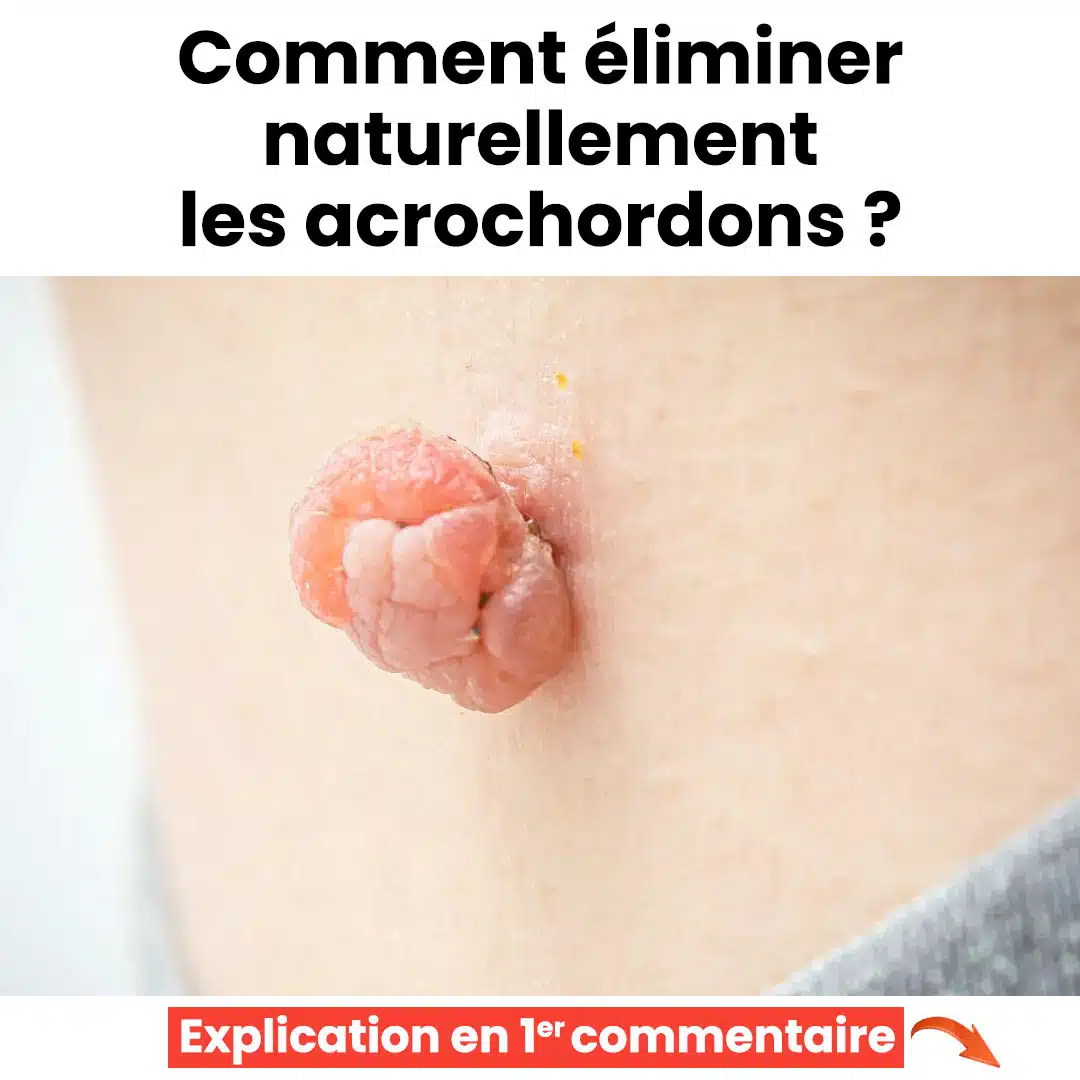 Comment éliminer les acrochordons de façon naturelle ?