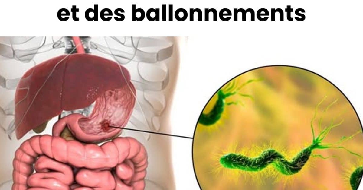 Comment éliminer les bactéries responsables des brûlures d'estomac et des ballonnements