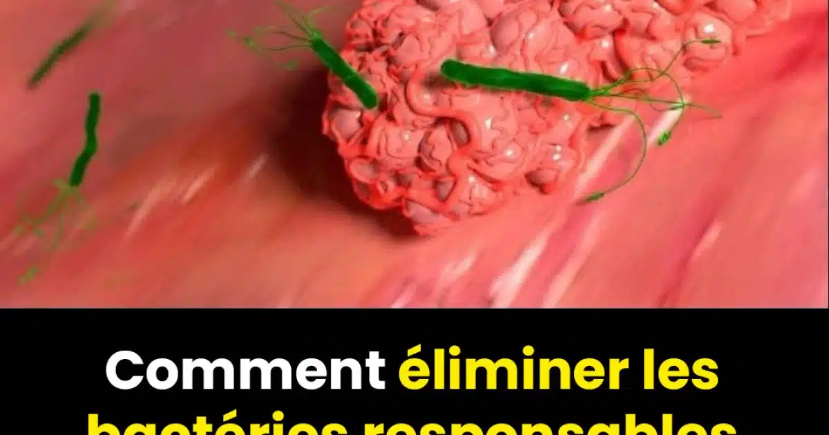 Comment éliminer naturellement la bactérie H. Pylori responsable des brûlures d'estomac et des ballonnements