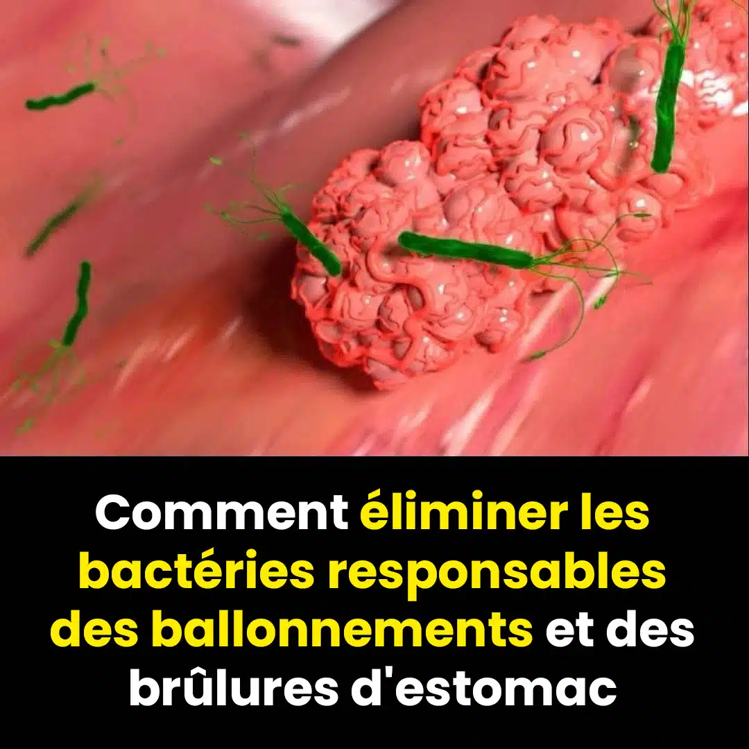 Comment éliminer naturellement la bactérie H. Pylori responsable des brûlures d'estomac et des ballonnements