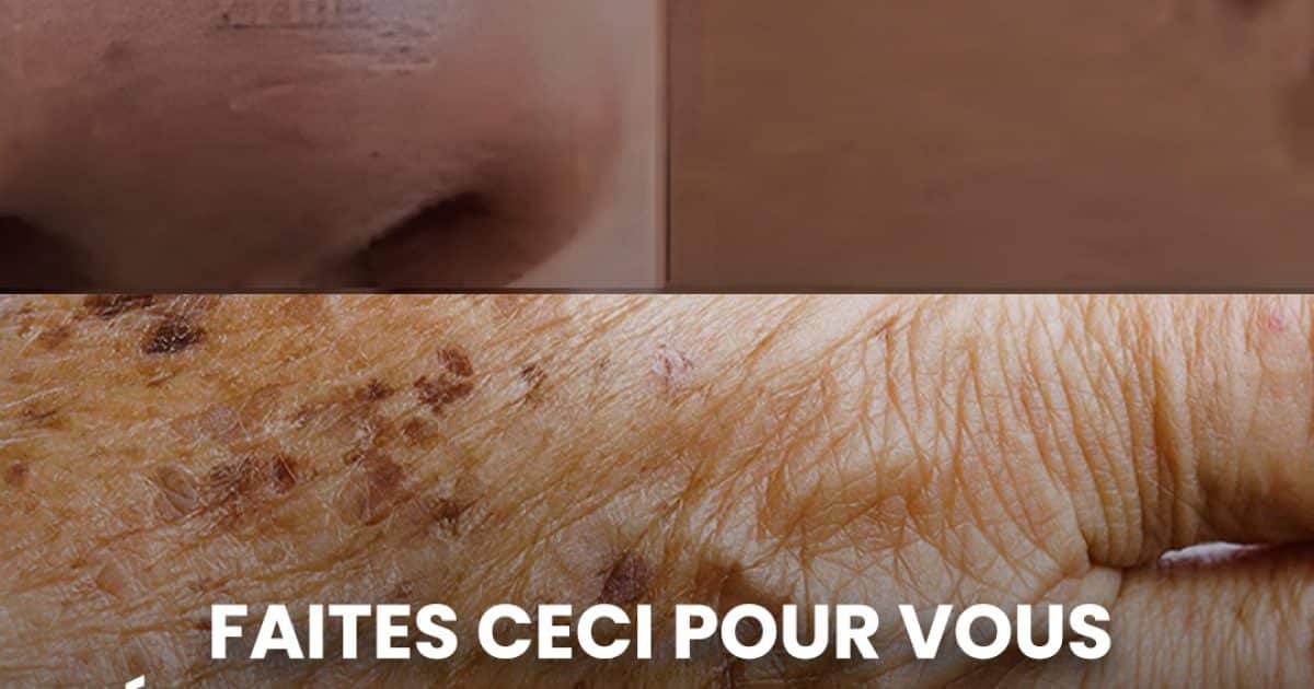 Comment éliminer naturellement les grains de beauté, les verrues, les points noirs, les acrochordons et les taches de vieillesse